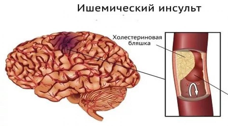 accident vascular cerebral pierde în greutate)