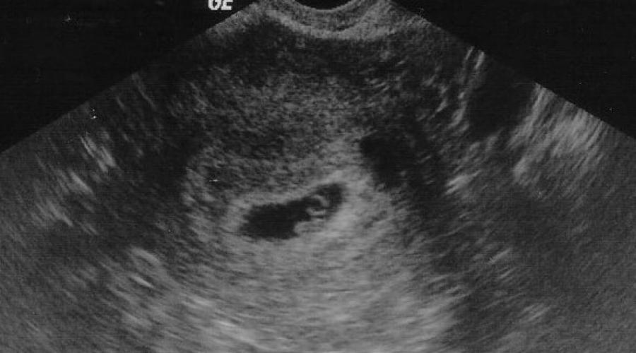 Někdy to ultrazvuk neukáže.  Test je pozitivní, ale ultrazvuk neukazuje těhotenství: co dělat?  Kdy je těhotenství vidět na ultrazvuku?