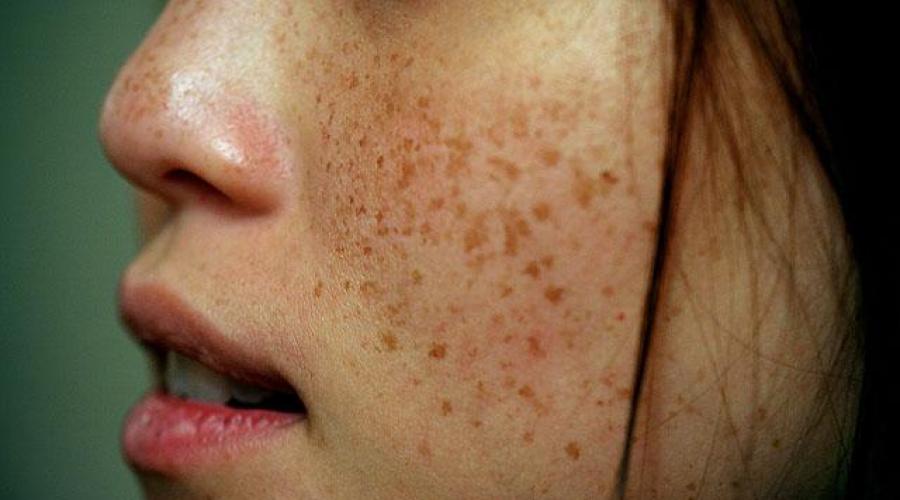 Пігментні плями на носі причини та лікування.  Чому з'являються пігментні плями та як їх видалити?  Механічні ушкодження шкіри
