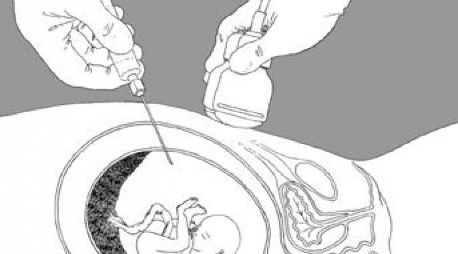 Známky úniku plodové vody ve třetím trimestru.  Únik plodové vody během těhotenství: jak zjistit, co je nebezpečné, co dělat?  Jak pochopit, že plodová voda uniká: příznaky, příznaky, příčiny, test ve druhém a třetím semestru těhotenství